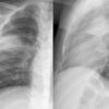 Round pneumonia 
different case