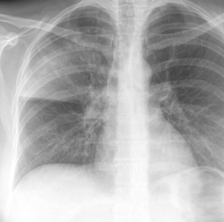 Case 7 RUL pneum PA