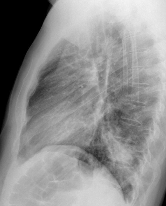 Case 9 RLL brpneum Lat