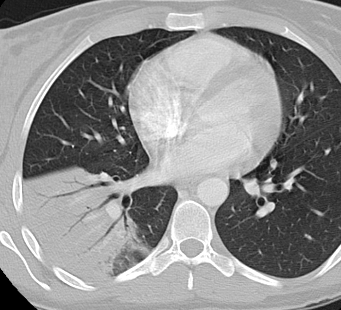 Case 14 RLL pneum CT