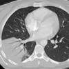 Case 14 RLL pneum CT