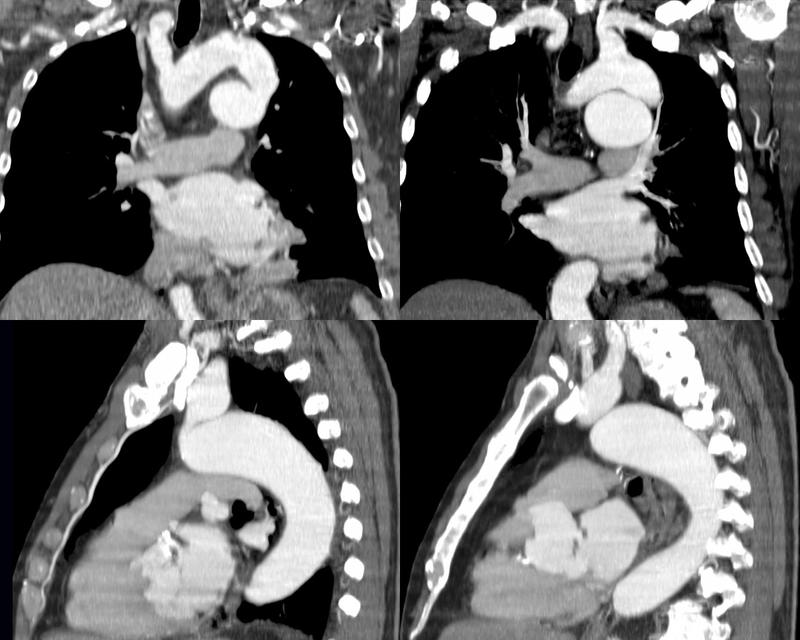 PseudoCoarc 3b