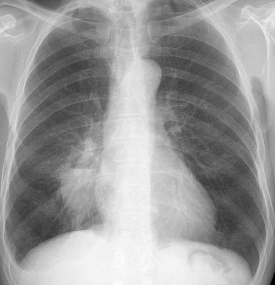 Case 16 Pneumonia PA