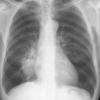 Case 16 Pneumonia PA