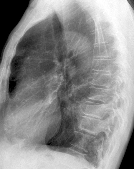 Case 16 Pneumonia Lat