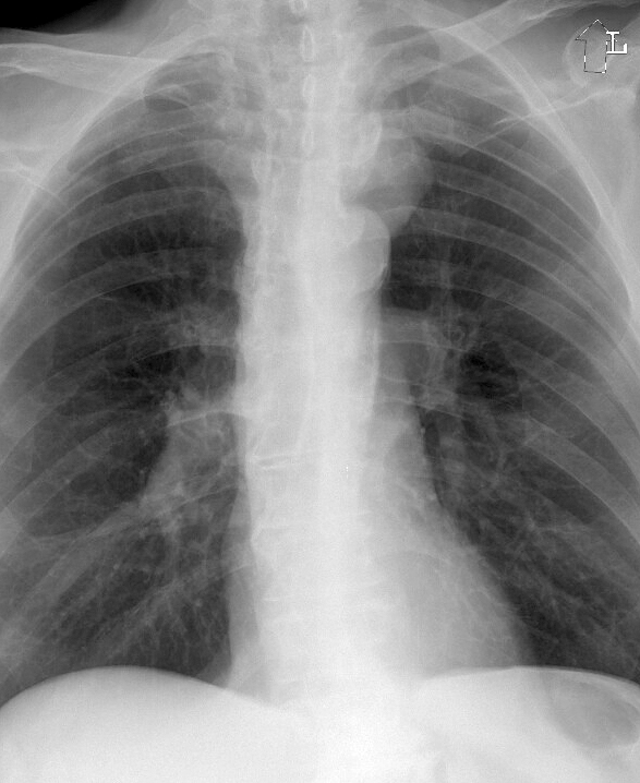 PseudoCoarc 4a