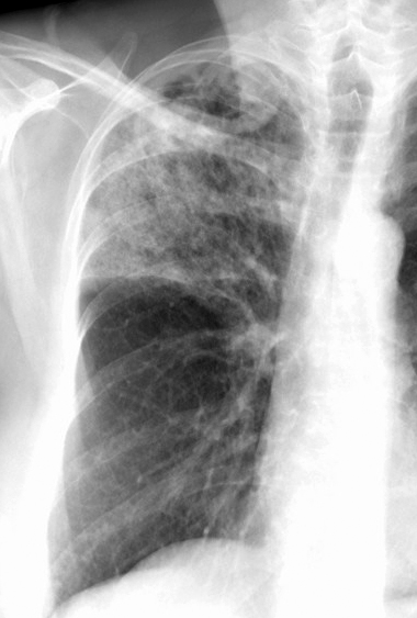 Case 17 Pneum with abscess PA