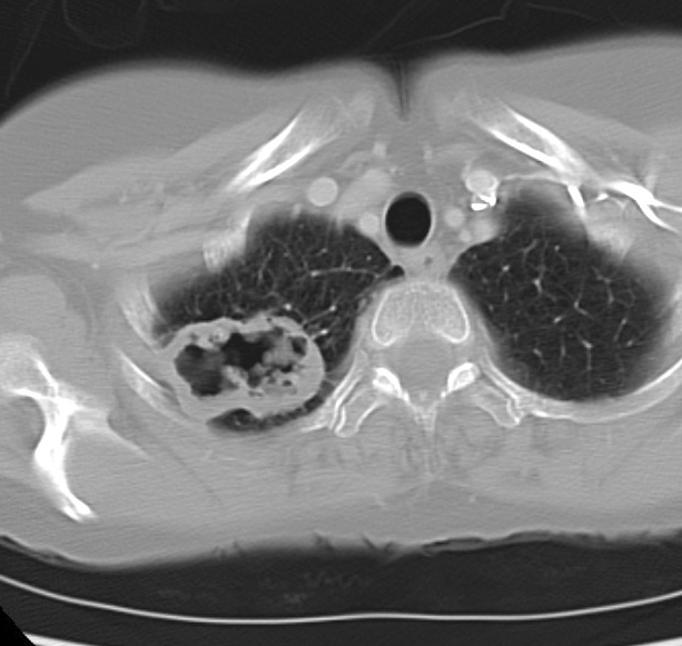 Case 17 Pneum with abscessCT