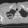 Case 17 Pneum with abscessCT