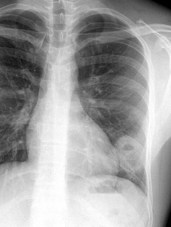 Case 18 Cavitating pneum/Abscess PA