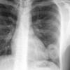 Case 18 Cavitating pneum/Abscess PA