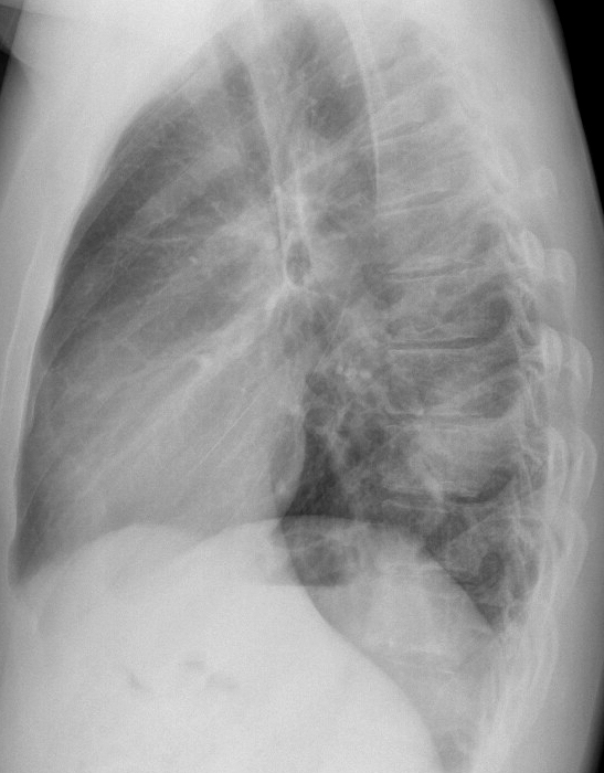 Case 18 Cavitating pneum/Abscess Lat