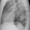 Case 18 Cavitating pneum/Abscess Lat