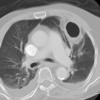 Abscess CT