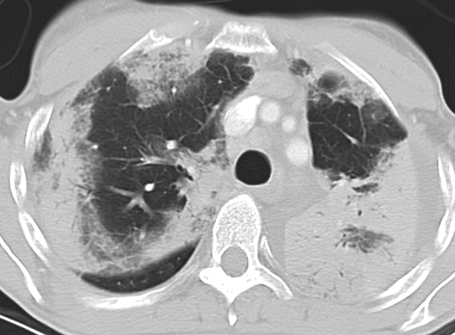 Eos Pneum (AEP) CT