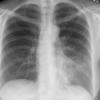 Lingular pneumonia PA