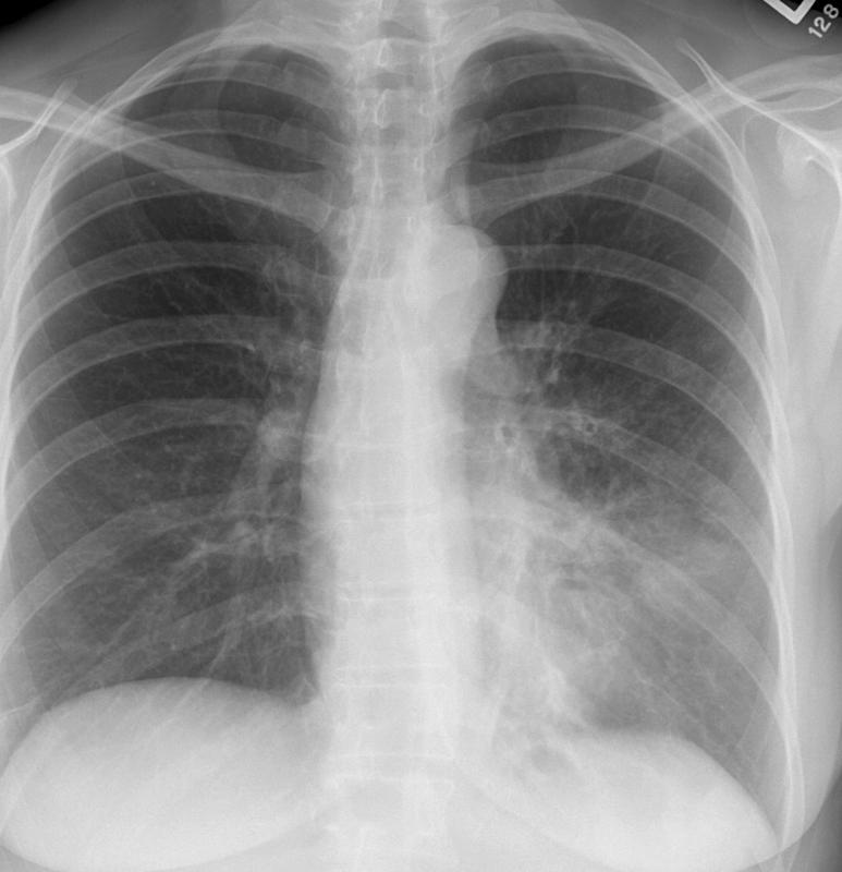 Lingular pneumonia PA