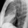 Lingular pneumonia Lat