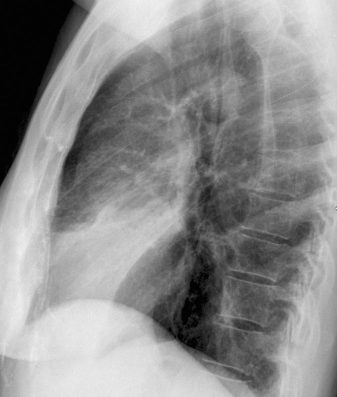 Lingular pneumonia Lat