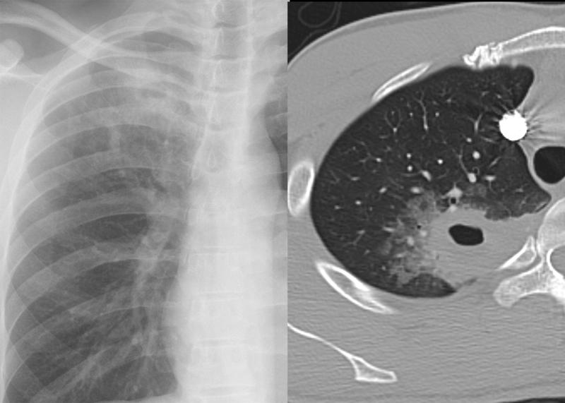 Cavitating pneumonia