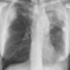 eosinophilic pneumonia