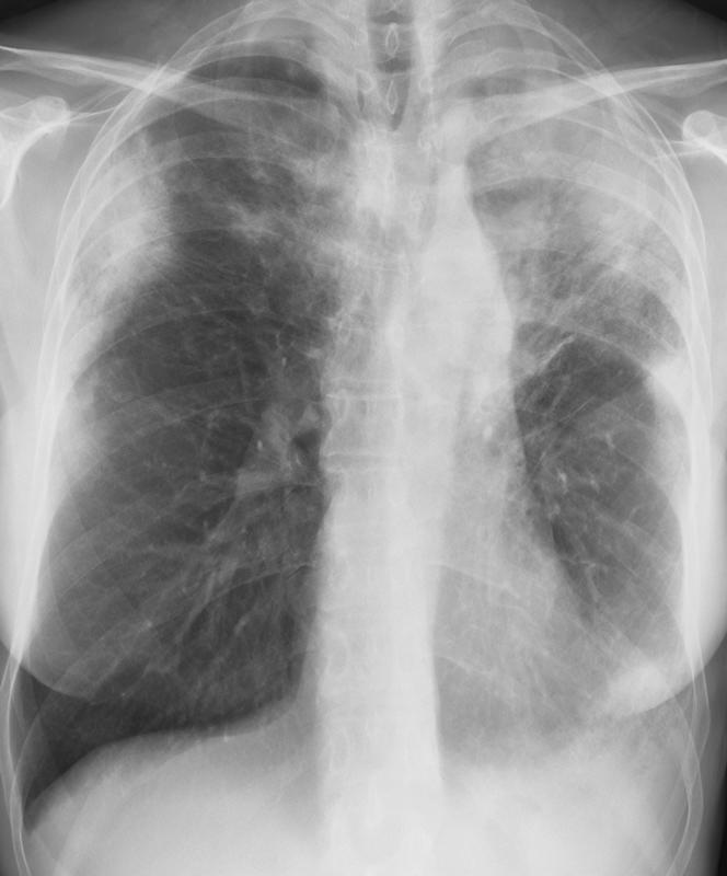 eosinophilic pneumonia