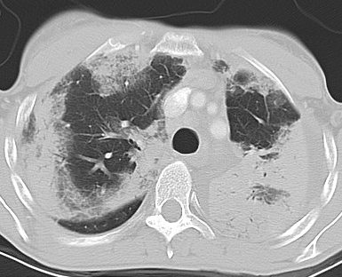 eosinophilic pneumonia