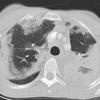 eosinophilic pneumonia