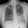 lingular pneumonia PA