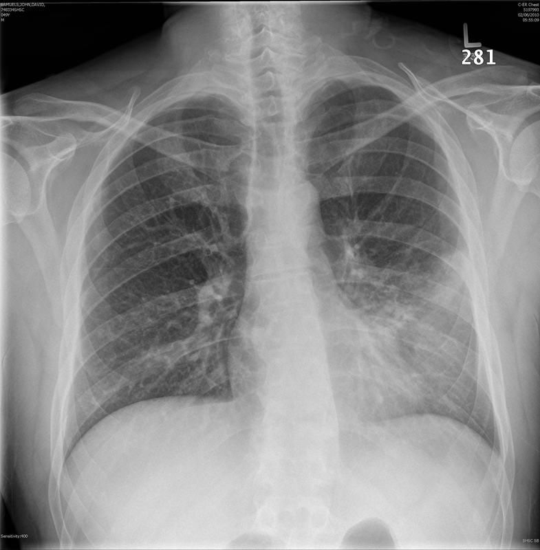 lingular pneumonia PA