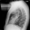 lingular pneumonia lat 