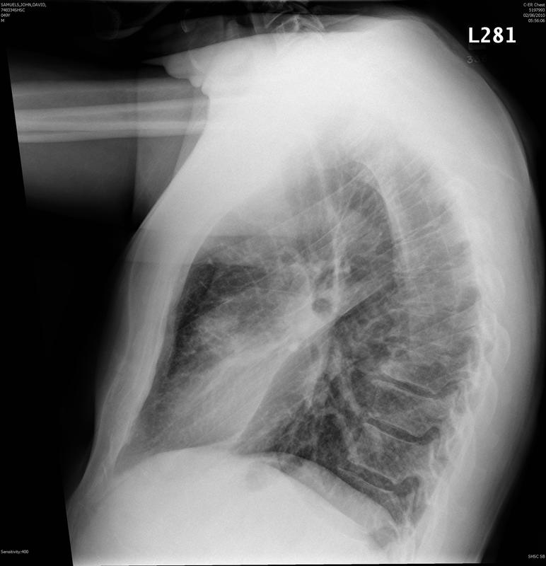 lingular pneumonia lat 