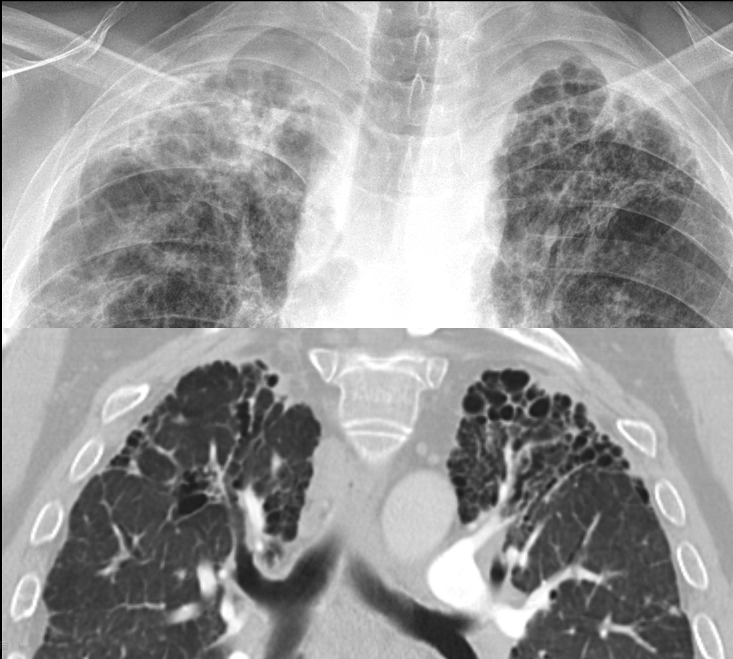 fibrosis - traction bronch