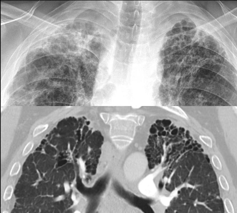 fibrosis - traction bronch