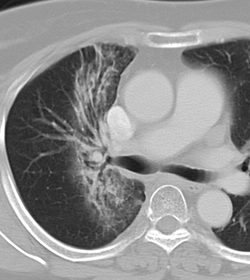 Radiation case 1