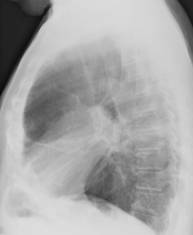 Radiation case 3