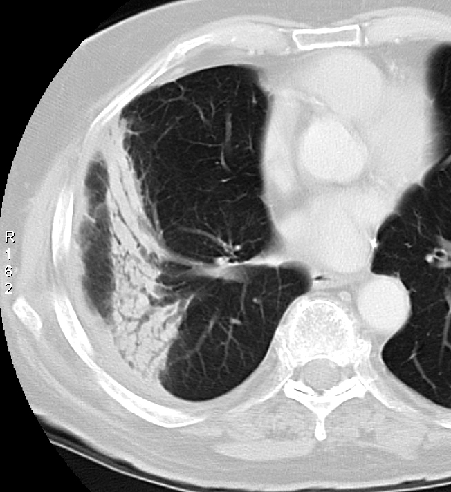 Radiation case 5
July