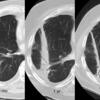 Radiation Case 5 seq