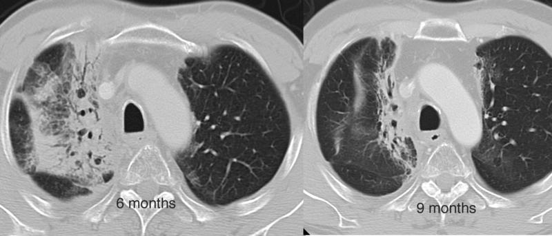 Radiation case 6