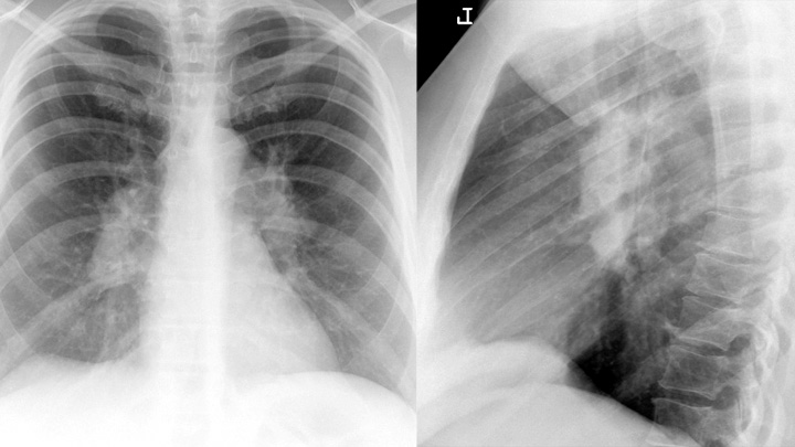 Sarcoid
Case 1 PA & Lat