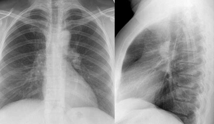 Sarcoid
Case 2 PA & Lat