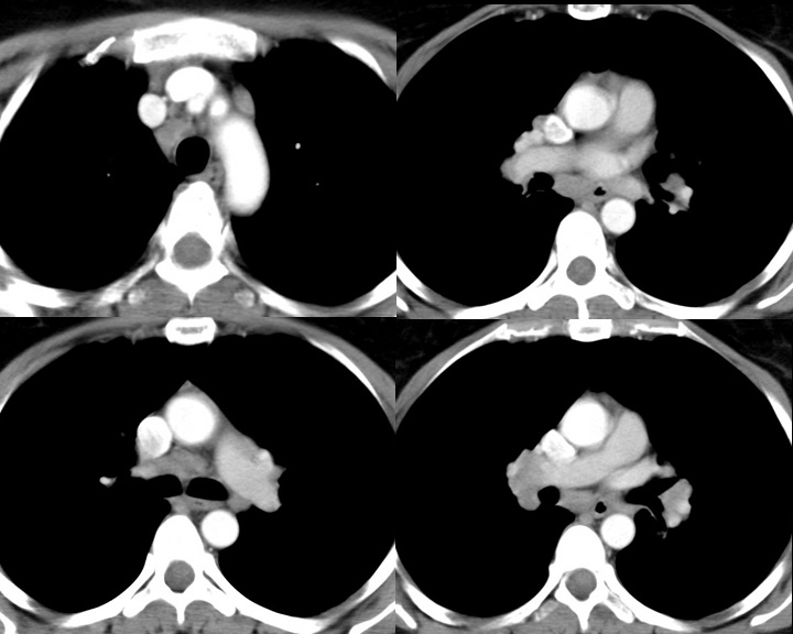 Sarcoid
Case 2 CT