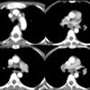 Sarcoid
Case 2 CT