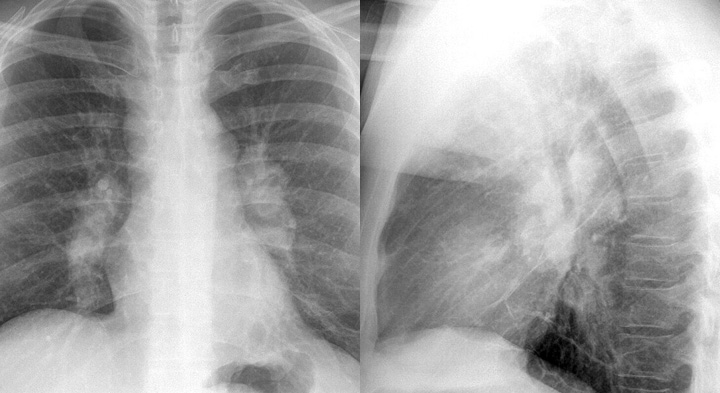 Sarcoid
Case 3 PA & Lat