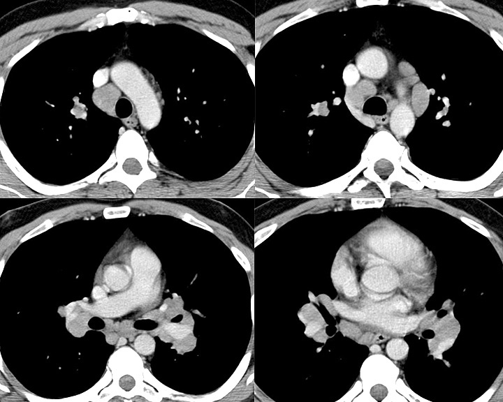 Sarcoid
Case 3 CT