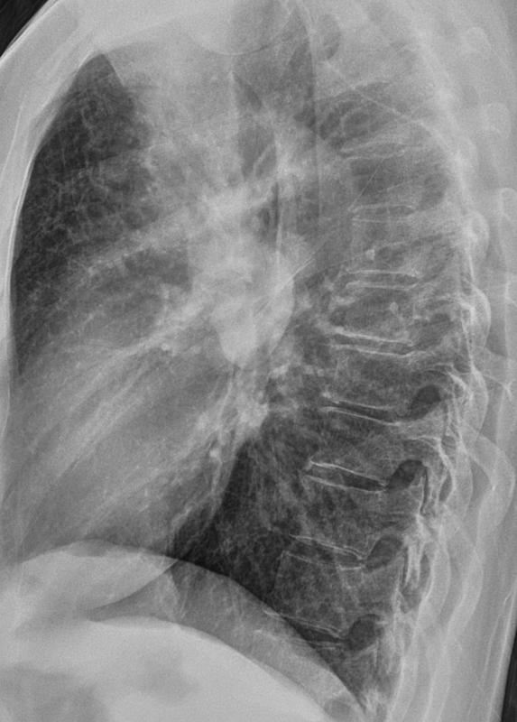 Sarcoid lateral
Case 4 