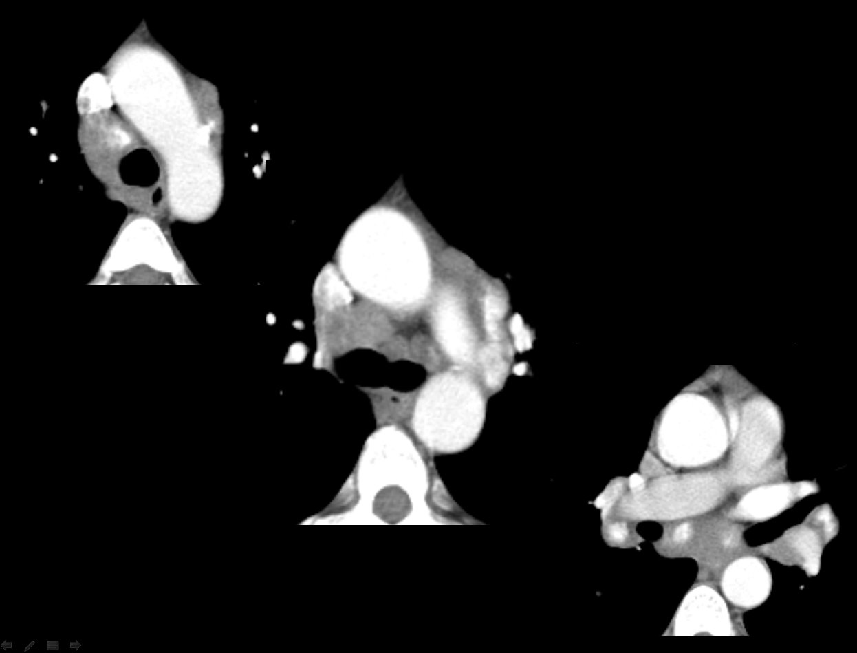 Sarcoid CT
Case 4 