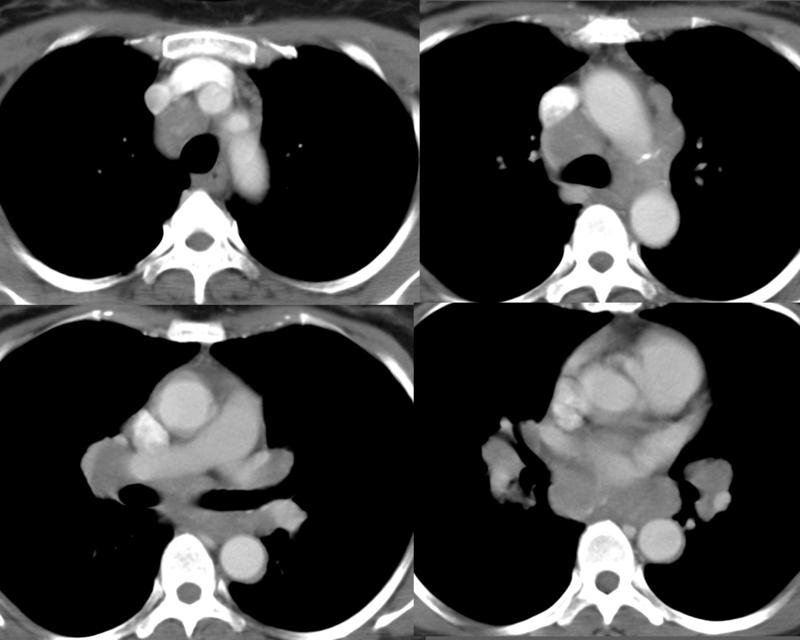 Sarcoid
Case 5 CT