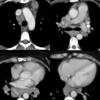 Sarcoid nodes with calcification