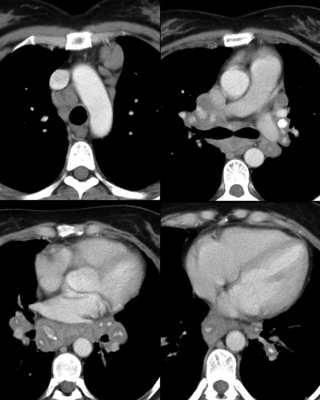 Sarcoid nodes with calcification